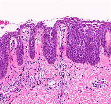 Central Cyanosis Lips Pathology Outlines Infoupdate Org