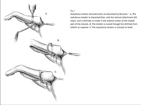 Bone structure of manubrium | Semantic Scholar