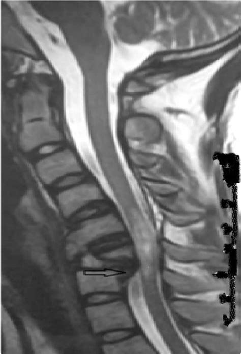 Mri Sagittal Section T Weighted Image Showing Fracture Of Sixth