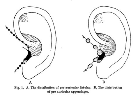 Hearing Outer Ear Development Embryology