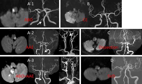 Lateral Pontine Syndrome Mri