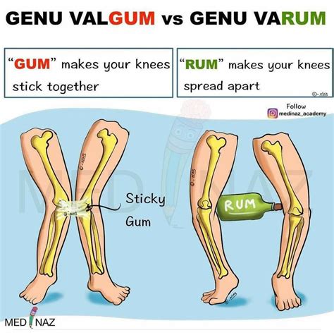 Genu Valgum Vs Genu Varum Artofit