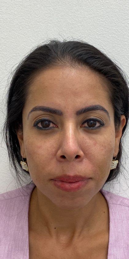 Patient Facial Fillers Before And After Photos Alhambra Plastic