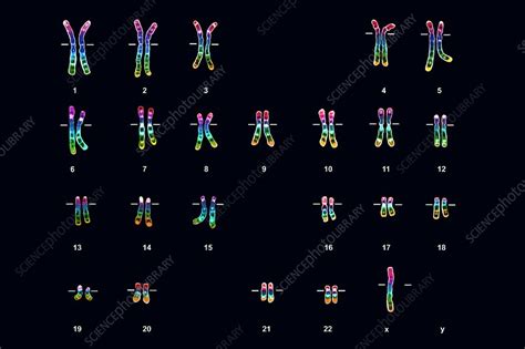 Turner S Syndrome Karyotype Female Stock Image C003 7180 Science