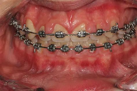 Gingival Hyperplasia Its Causes Symptoms And Treatment Healthy Rounds