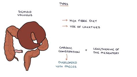 Understanding Volvulus Twisted Bowel Youtube