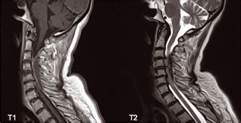 Spontaneous Cervical Epidural Hematoma Mimicking Stroke A New The