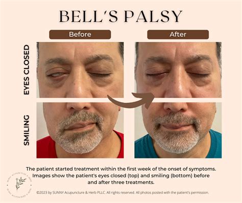 Treat Bells Palsy With Acupuncture — Sunny Acupuncture And Herb