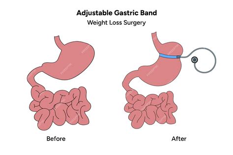 Premium Vector Adjustable Gastric Band Bariatric Surgery Procedures