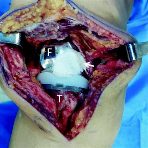 Intraoperative Photography Of A Right Side TKA Surgical Wound After