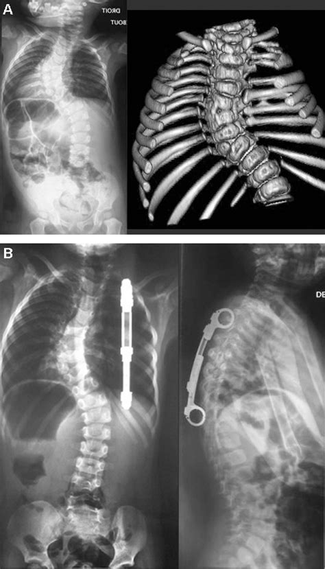 Figure 16 From Early Onset Scoliosis Current Treatment Semantic Scholar