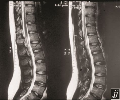 Radioogle | Spine- lumbar vertebral fracture