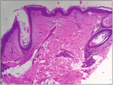 Histopathology Hande 40× A Skin Punch Biopsy From The Scalp Revealed