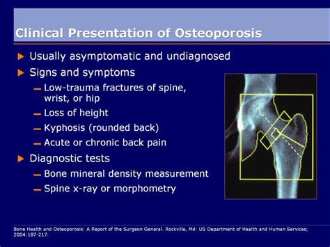 Ppt Osteoporosis Powerpoint Presentation Free Download Id 1155300