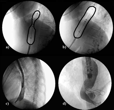 Combined Endoscopic And Radiographic Evaluation Of The Off