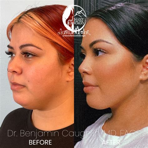 Combination Of Morpheus Jawline Sculpting Buccal Fat Removal Chin