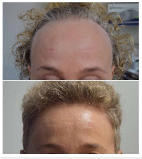 Frontal Hairline Before And After Treatment With Systemic