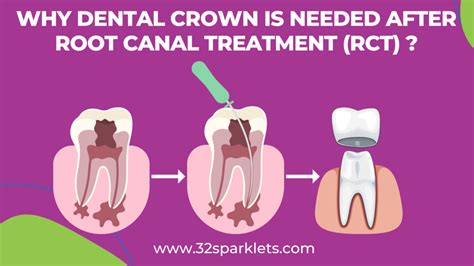 Why Dental Crown Or Cap Is Needed After Root Canal Treatment Rct