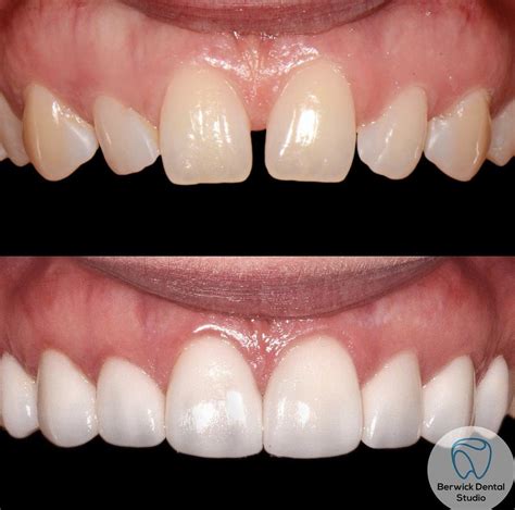 Transform Your Smile With The Smile Experts Berwick Dental Studio