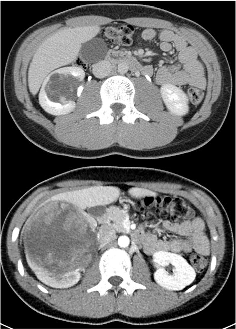 Primary Renal Synovial Sarcoma In A Year Old Boy Journal Of