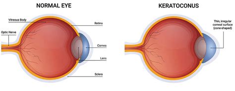 Corneal Cross Linking For Keratoconus At Washington Eye Institute