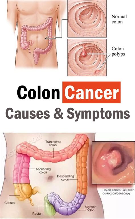 Colon Cancer Causes Symptoms Signs Amp Treatment Artofit