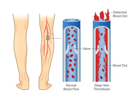 Medical Diagram Of Deep Vein Thrombosis At Leg Area Illustration About