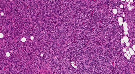 Dermatofibrosarcoma Pathology Outlines