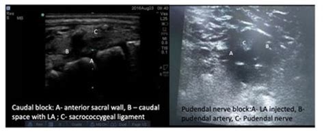 B47 Comparison Of Ultrasound Guided Pudendal Nerve Block With Caudal