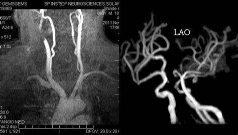 Dr Balaji Anvekar Frcr Stent In Situ Mr Angio