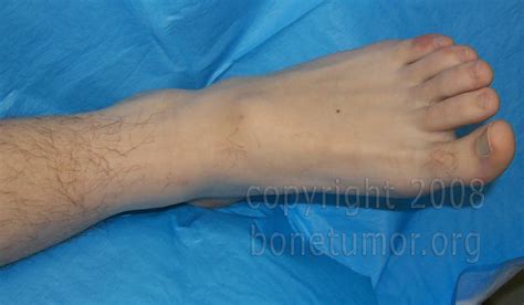 Giant cell tumor - Foot and Ankle | BoneTumor.org