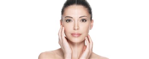 Botox Brow Lift Before And After – Everything You Need To Know - SA