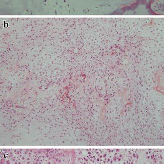 Histologic Features Of Chondrosarcoma A Grade Tumors Are Moderately