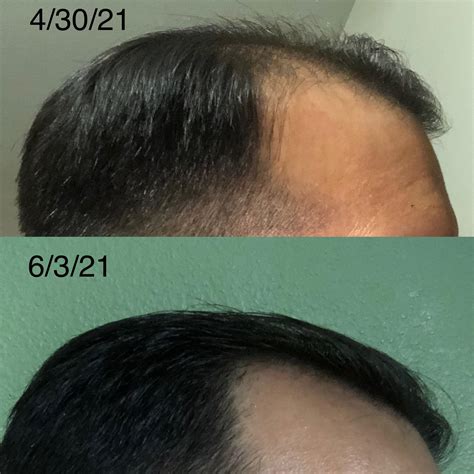 2 month results: Started minoxidil (target brand) on 4/13 once a day ...