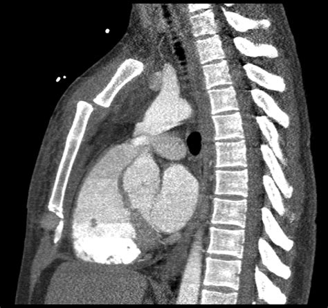 Contrast Enhanced Computed Tomography Sagittal Image Demonstrates