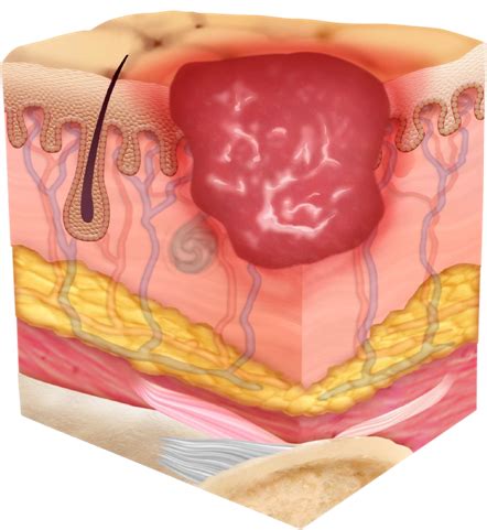 Preventing Pressure Ulcers Fisher Paykel Healthcare