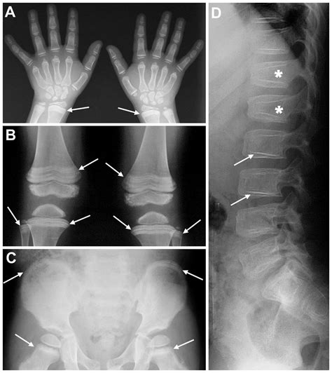 A Plain Radiograph Posterior Anterior Pa View Of The Hands B