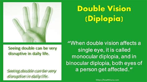 Double Vision Diplopia Causes Tests And Treatment Health Kura