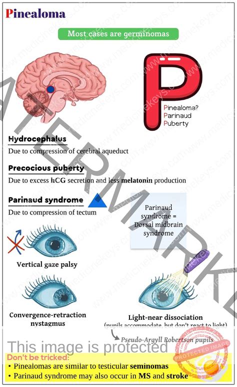 Pinealoma - Medicine Keys for MRCPs