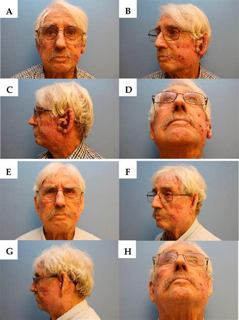 Figure 2 From Clinical Remission Of Cutaneous Squamous Cell Carcinoma