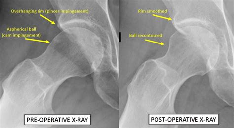 Hip Pain Xray Normal Holfaspen