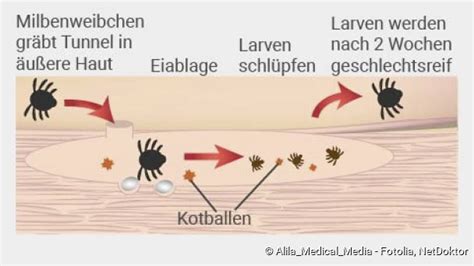 Krätze Scabies Ansteckung Sympome Behandlung NetDoktor