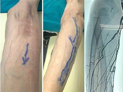 Multiple Fistula Thrombosis Marking Of Incisions And Phlebography Of Download Scientific