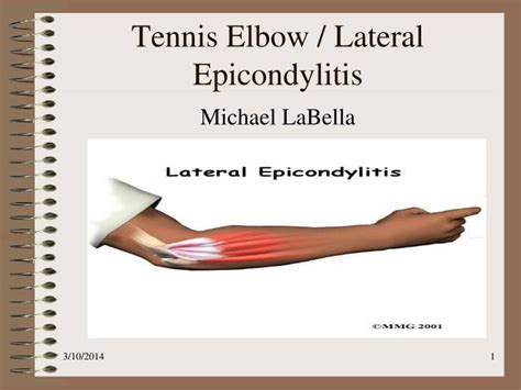 Ppt Tennis Elbow Lateral Epicondylitis Powerpoint Presentation