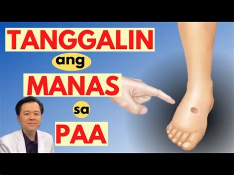 Tanggalin Ang Manas Sa Paa By Doc Willie Ong Internist And