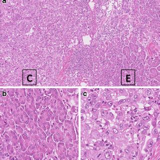 A Microscopic Image Of The Tumor Ectopic Pancreatic Tissue Showed