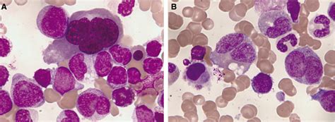 Bone Marrow Aspirate Maygr Nwaldgiemsa Stain Acute Myeloid