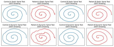 Sample Of Parkinsonhw Drawings The Top Row Of Drawings Is From The