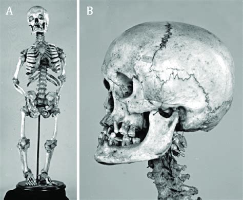 Achondroplasia A Complete Macerated Skeleton Showing Rhizomelic