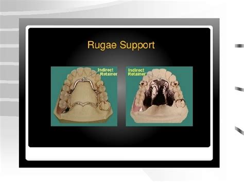 Indirect Retainers Movement Of Distal Extension Rpd Vertical